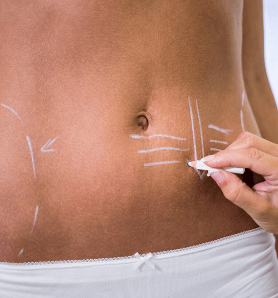 Abdominoplastia