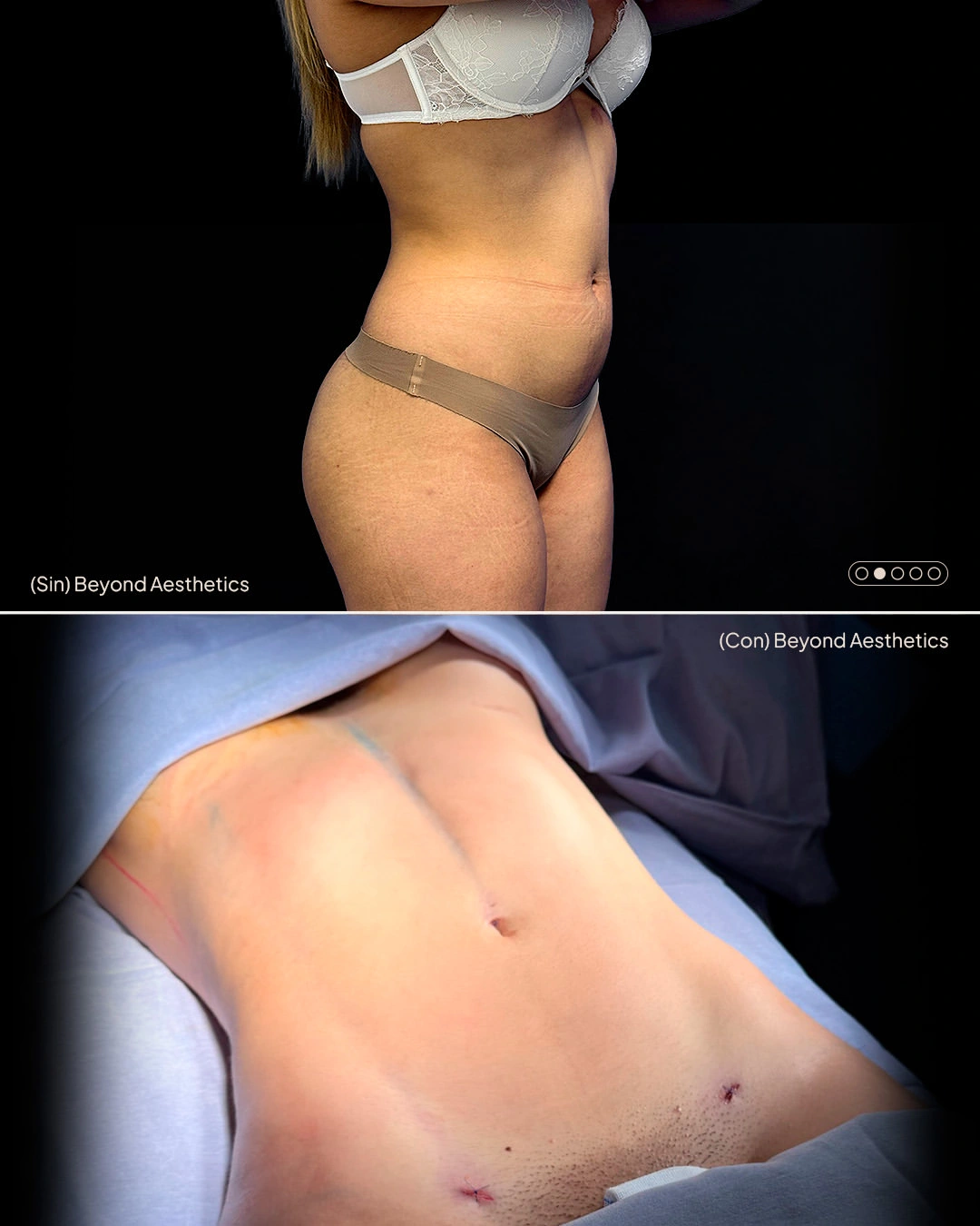 Antes y después de lipoescultura y contorno corporal realizado por el Dr. Carlos Rodríguez