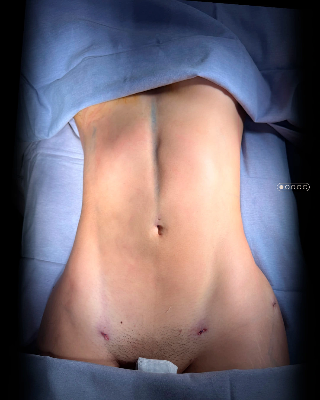 Lipoescultura y contorno corporal en Monterrey con el Dr. Carlos Rodríguez